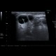 Malignant lymphoma, ultrasound of lymph nodes, correlation with CT and NM: US - Ultrasound